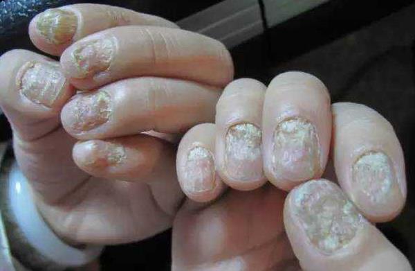 醋泡大蒜治疗灰指甲的方法